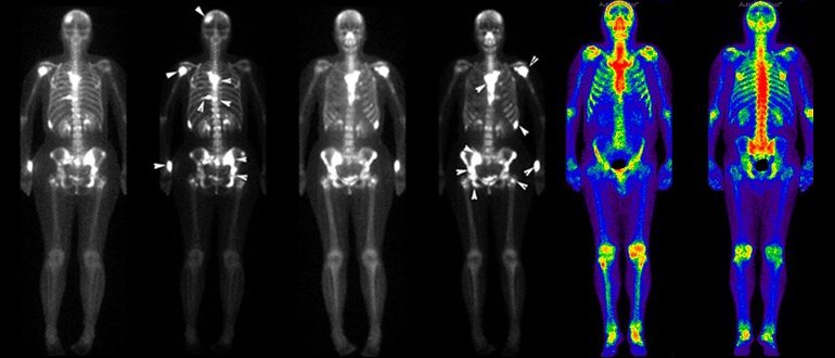 Сцинтиграфия костей скелета
