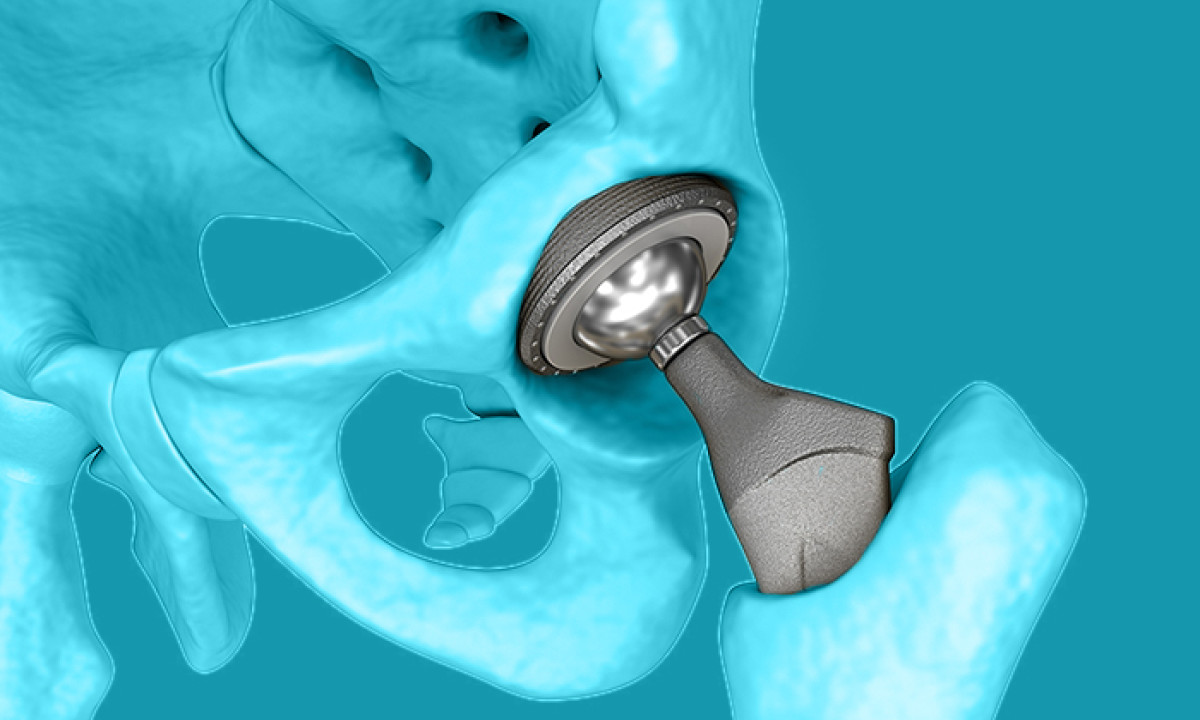 Титановый протез тазобедренного сустава